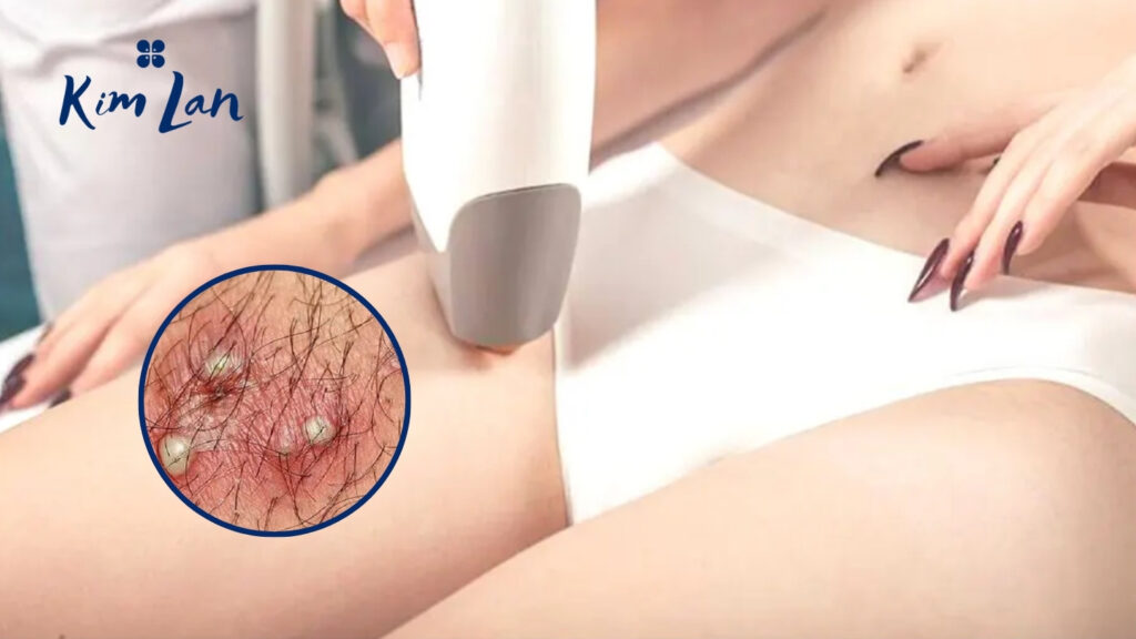 Triệt lông bikini bị nổi mụn