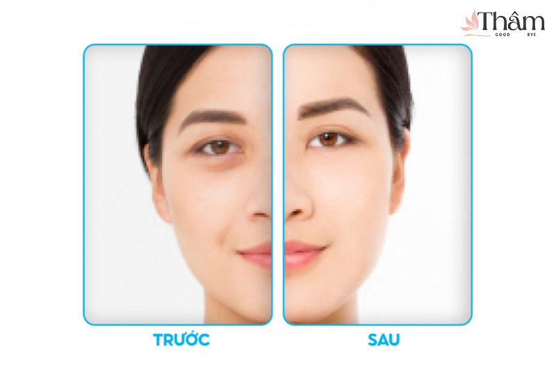 Trước và sau khi sử dụng kem trị thâm Uriage