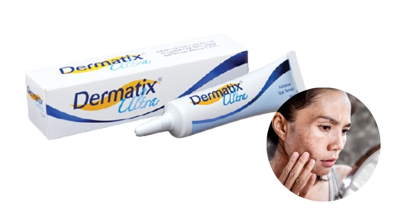 review kem trị mụn thâm dermatix ultra