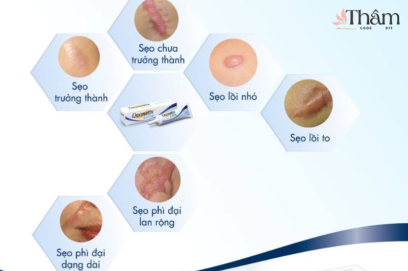 Kem trị sẹo Dermatix phù hợp trị seho lồi, phì đại