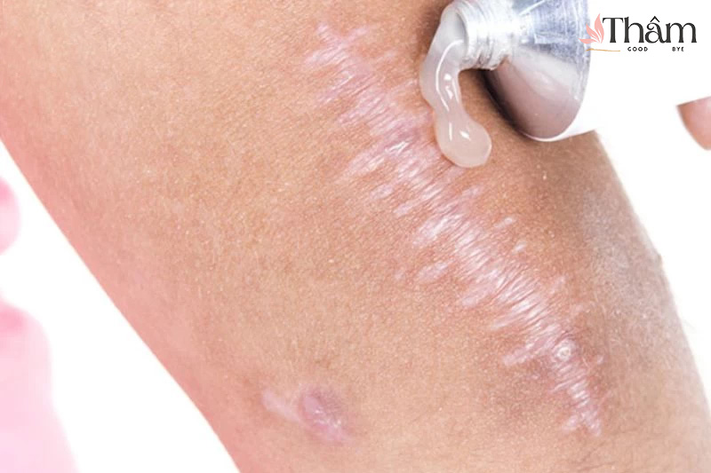Thoa kem trị sẹo lên da