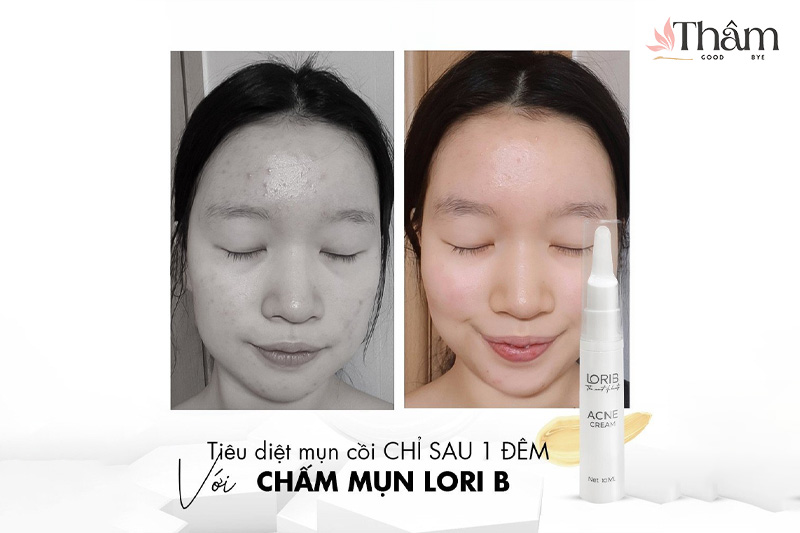 Làn da trước và sau khi sử dụng kem trị thâm lori b