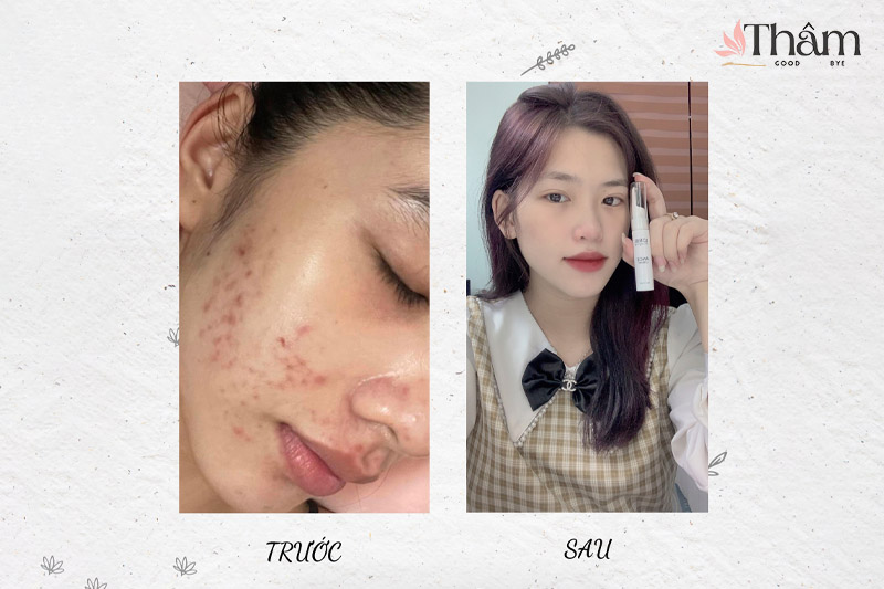 Làn da trước và sau khi sử dụng kem trị mụn lori b