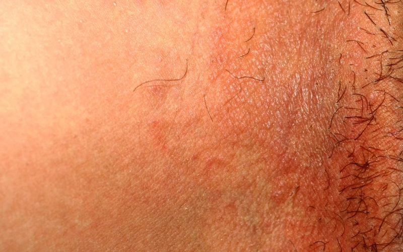 kem trị thâm bẹn