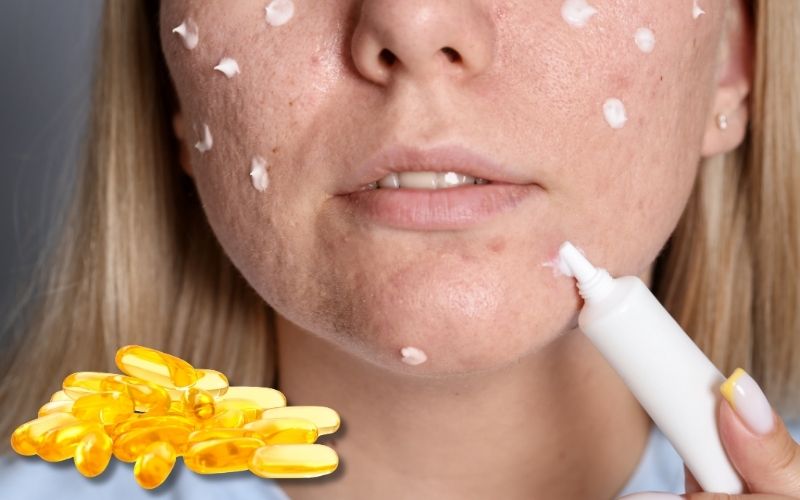 kem trị thâm dầu cá