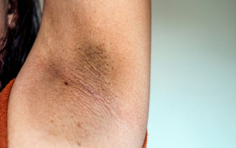 sản phẩm trị thâm nách