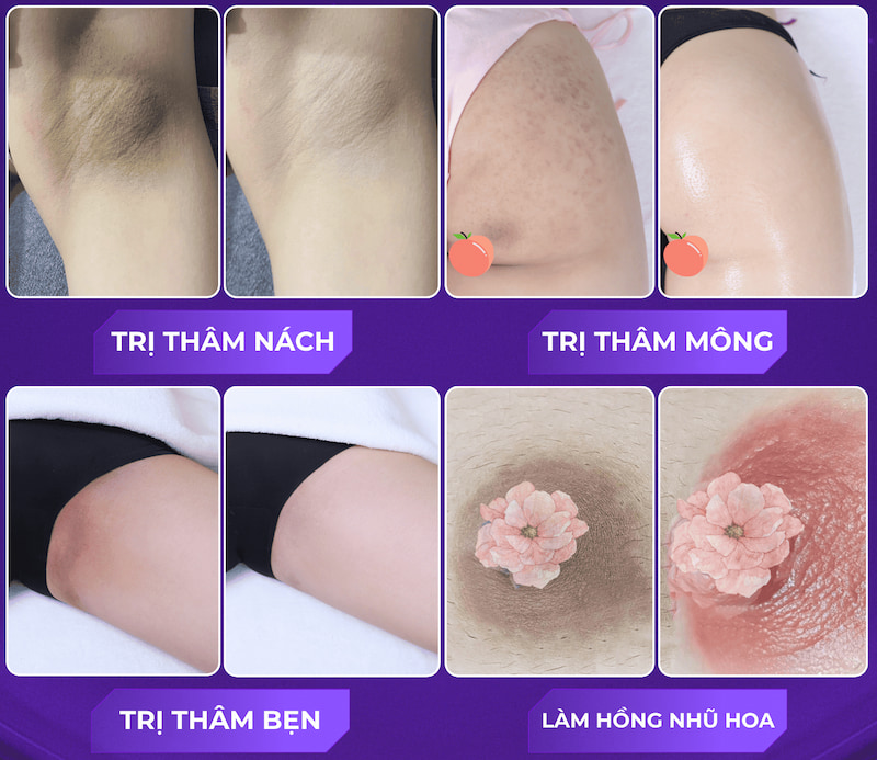Kết quả thực tế điều trị thâm an toàn tại LG Clinic