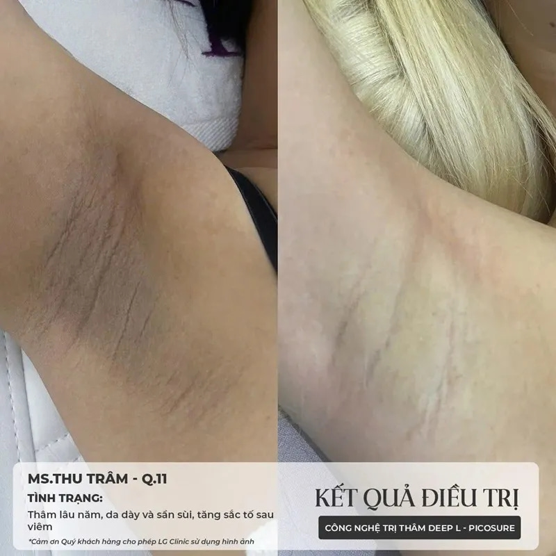 kết quả trị thâm nách tại lg clinic