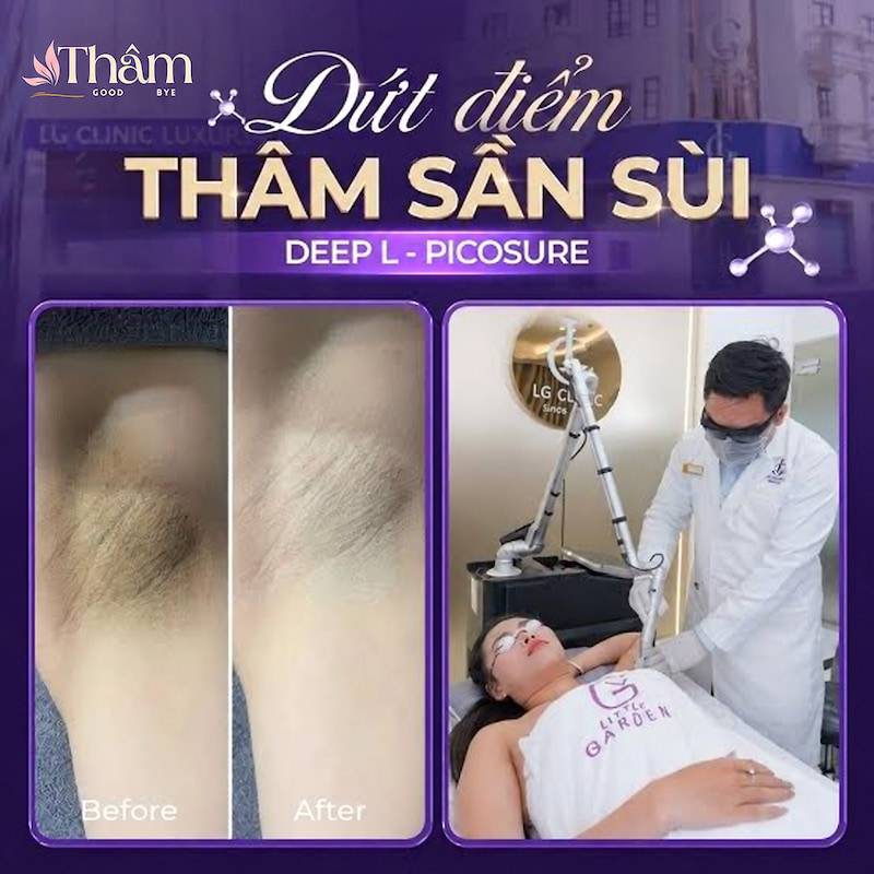 Phòng khám da liễu lg clinic trị thâm nách