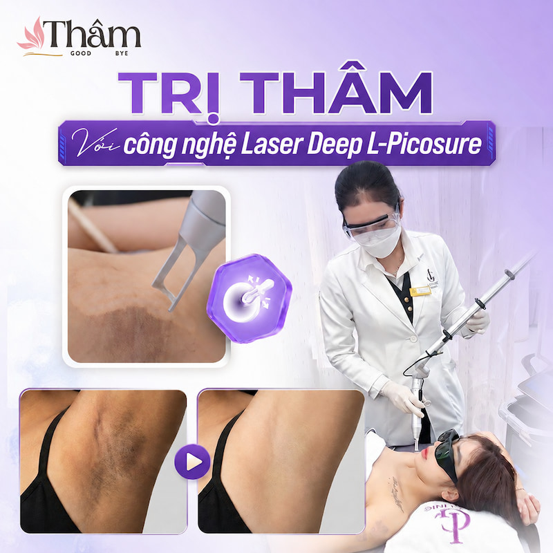 Công nghệ Deep L-Picosure tại LG Clinic trị thâm